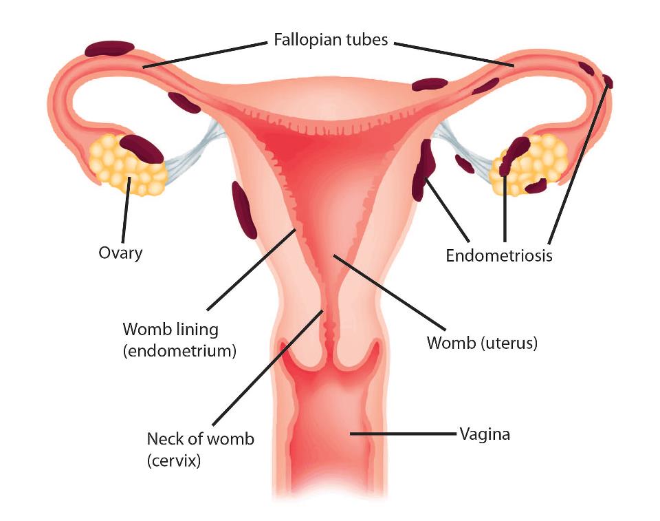 endometriosis pic